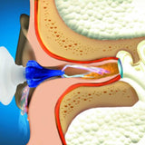 Macks Tri-Syringe for Earwax Removal